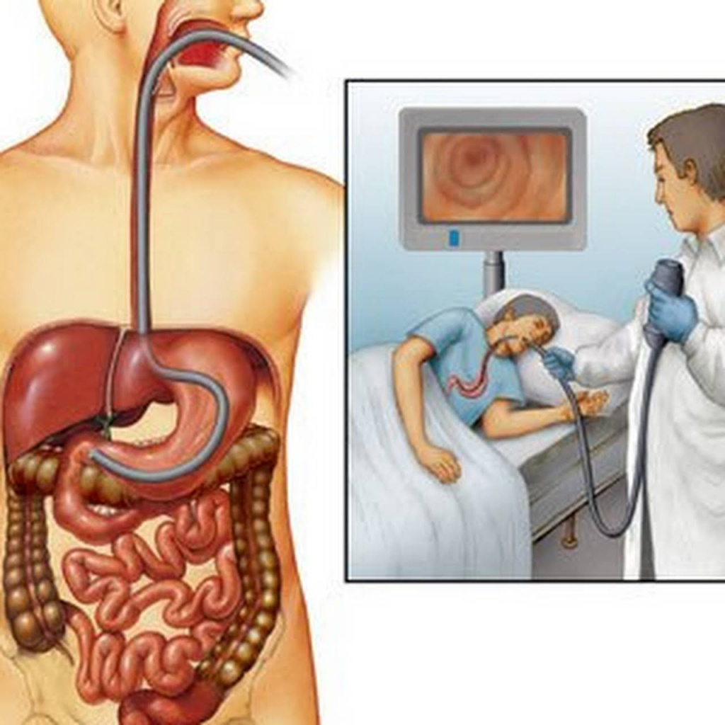 Видеоэзофагогастродуоденоскопия (ВЭГДС)