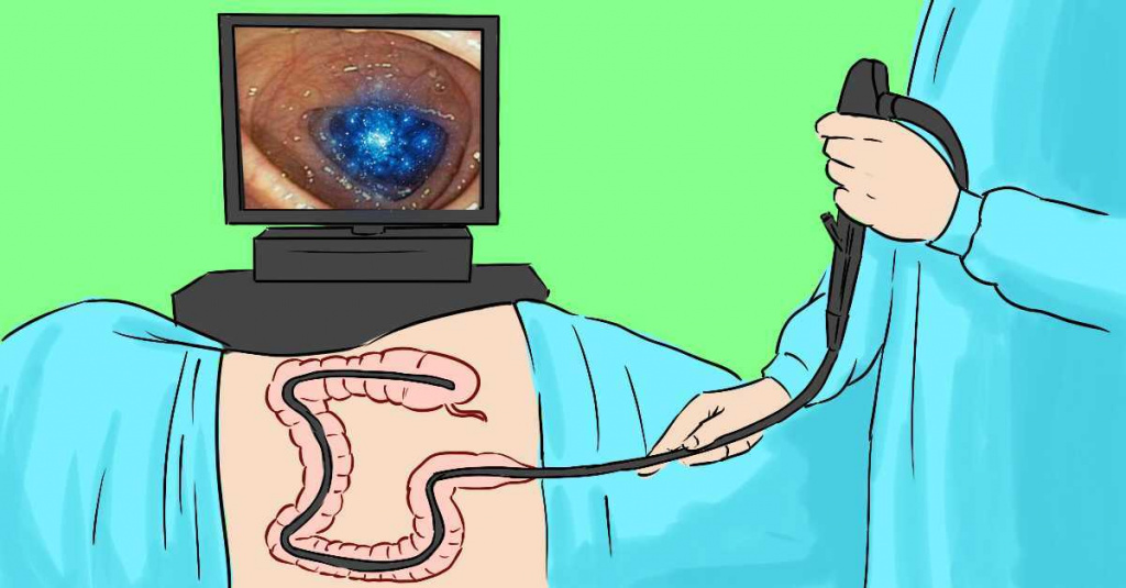 Видеоколоноскопия